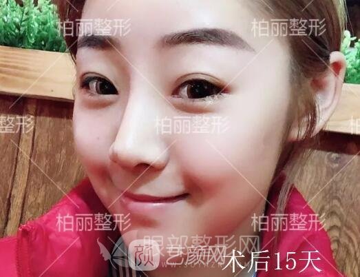 開眼角多久恢復(fù) 術(shù)后15天果分享