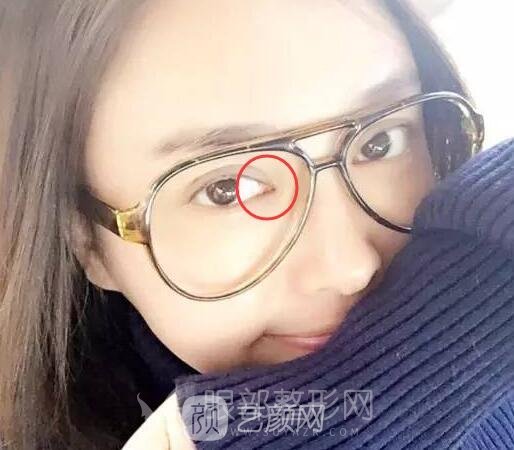 明星也要開眼角