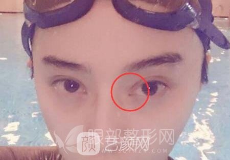 開眼角手術(shù)明星也愛