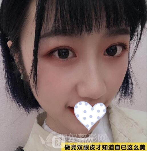 開眼角需要多長時間恢復(fù)