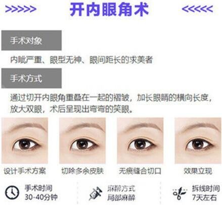 開內(nèi)眼角手術(shù)怎么做