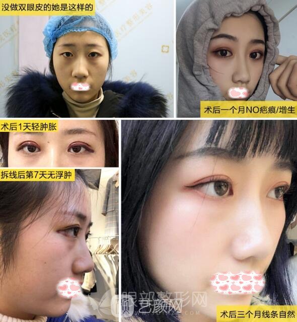 醫(yī)生告訴我開眼角需要多長時間恢復(fù)，我來解答！