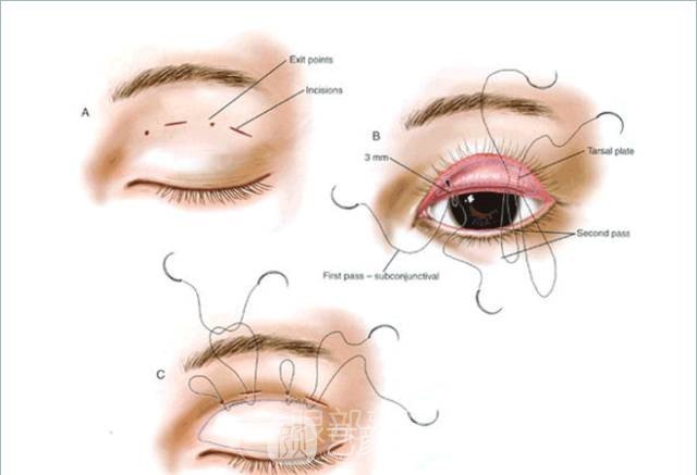 高分子雙眼皮輕松讓你變成女神，成為人群中較靚的那一個！