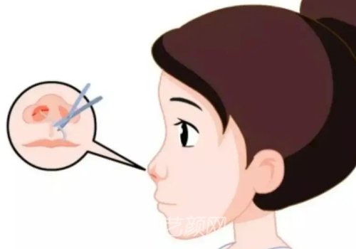 李健做鼻子效果圖一覽|醫(yī)