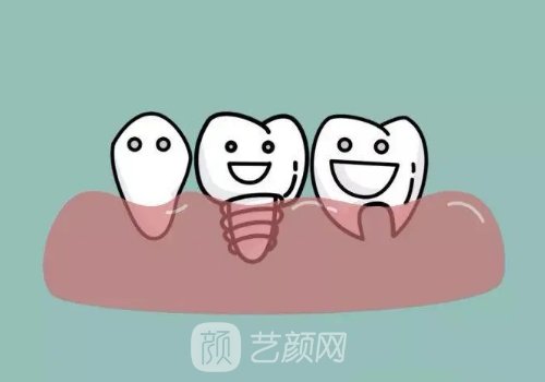 韓國美格真種植體的優(yōu)缺