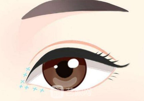 內眼角回包一般能成功嗎