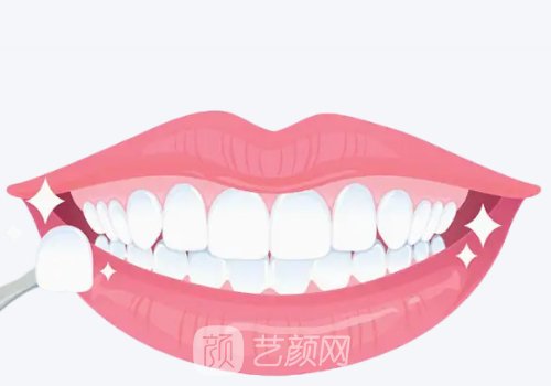 鑄瓷貼面和全瓷貼面價(jià)格