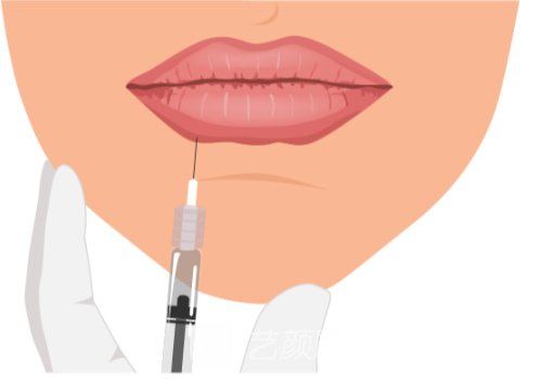 莫娜麗莎玻尿酸適合打唇