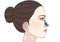 骨雕鼻子多少錢?耳軟骨低