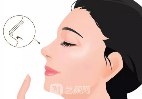 骨雕鼻可以維持多久?一般