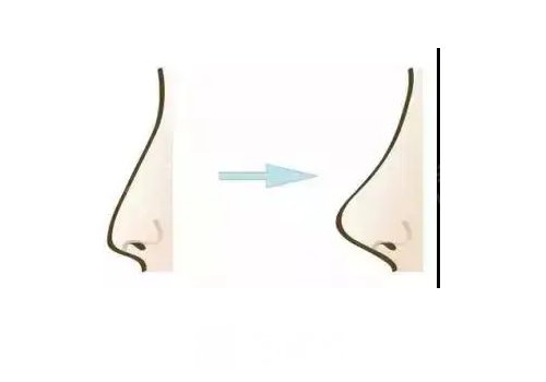 少女針填充鼻子什么時候