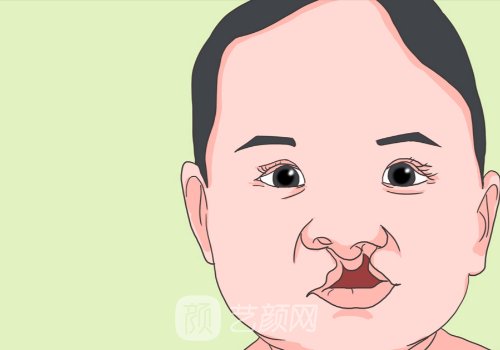 兔唇免費(fèi)修復(fù)的條件是什