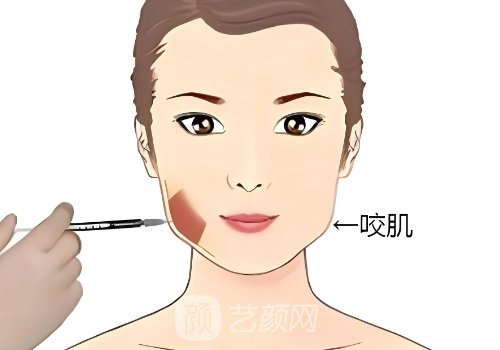 輕薄針一針多少毫升?科普