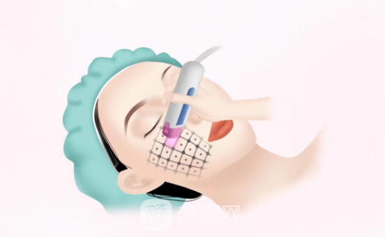 金達威聚拉美超聲刀效果