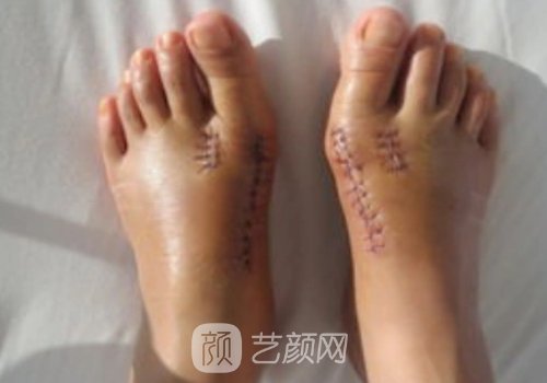 腳骨拐矯正需要多少錢?價