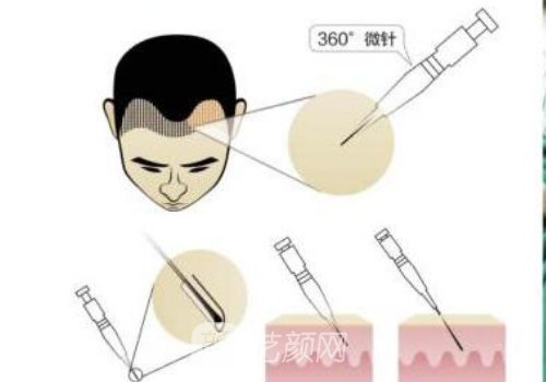 廣州毛發(fā)種植多少錢?醫(yī)院