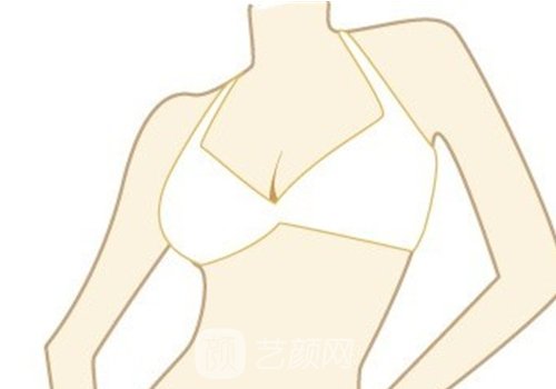 蝴蝶臂吸脂吸什么位置?注