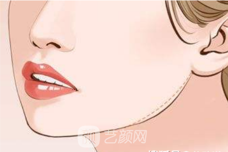 下頜角磨骨手術(shù)需要多少